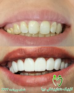 نمونه کار دندانپزشکی زیبایی کامپوزیت کلینیک دندانپزشکی دیبا