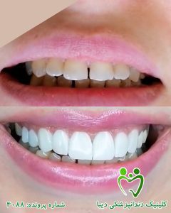نمونه کار دندانپزشکی زیبایی کامپوزیت کلینیک دندانپزشکی دیبا