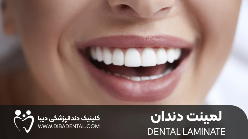 لمینت دندان