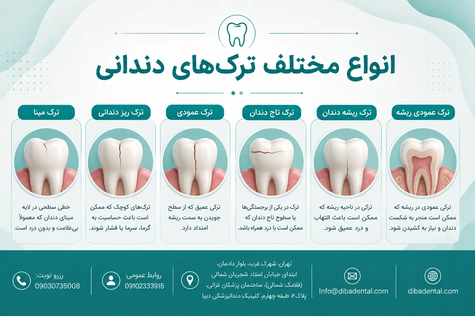 ترک خوردن دندان: علائم، علت‌ها و جدیدترین روش‌های درمان