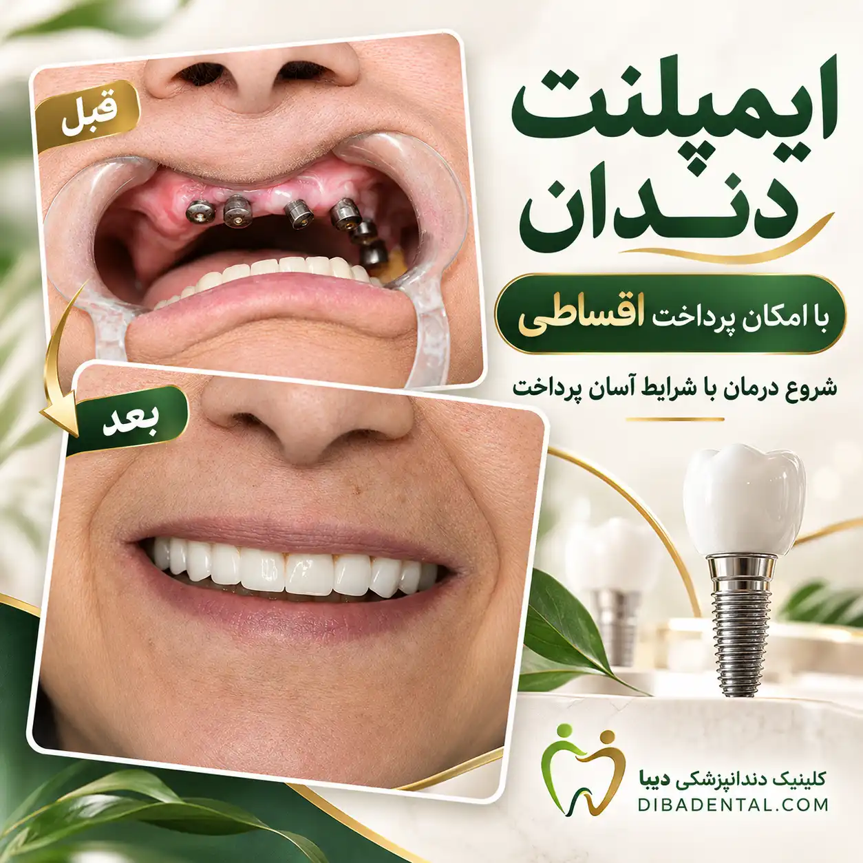 نمونه‌کار ایمپلنت دندان